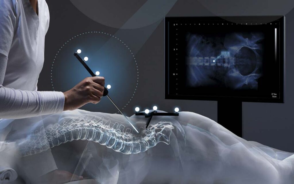 Illustrative rendering of an optical tracking workflow showing a clinician holding a handheld instrument with passive marker spheres above a patient model, with a reference tool array positioned on the back, an overlaid spine visualization, and a monitor displaying anatomical imagery.