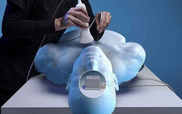 EM navigated thyroid procedure using ultrasound and navigated needle.